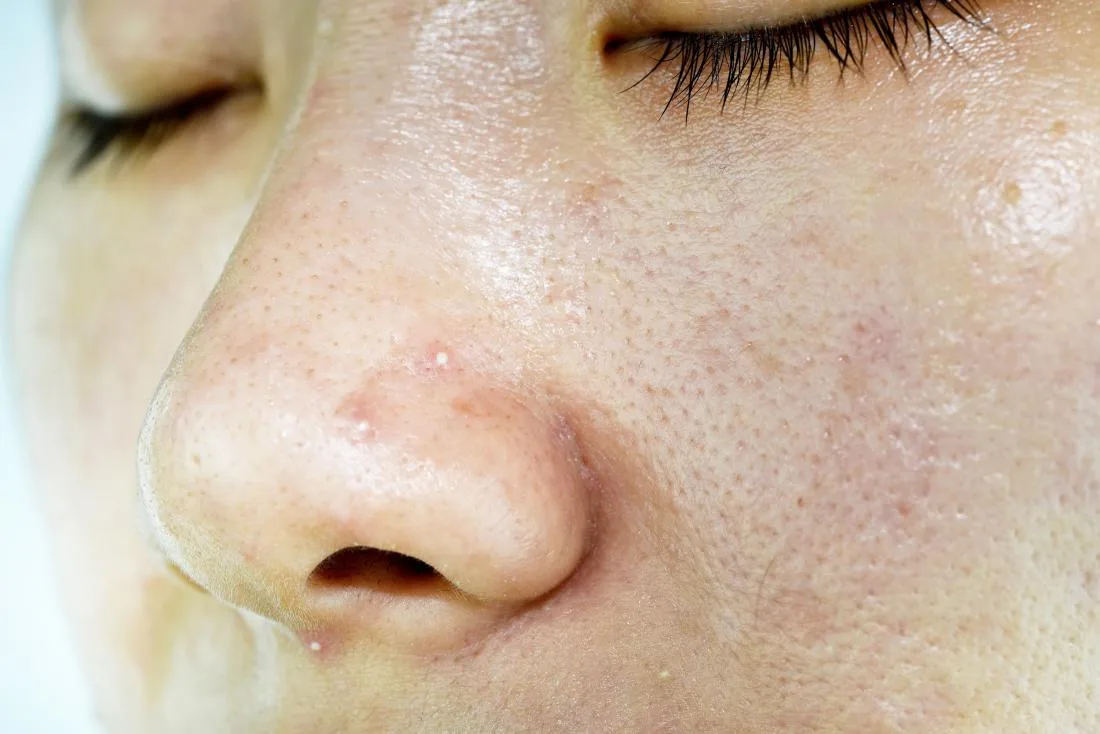 how to reduce oily skin shine