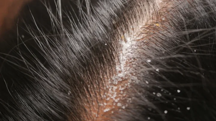 Why Your Scalp Gets So Dry in Winter (And How to Fix It)